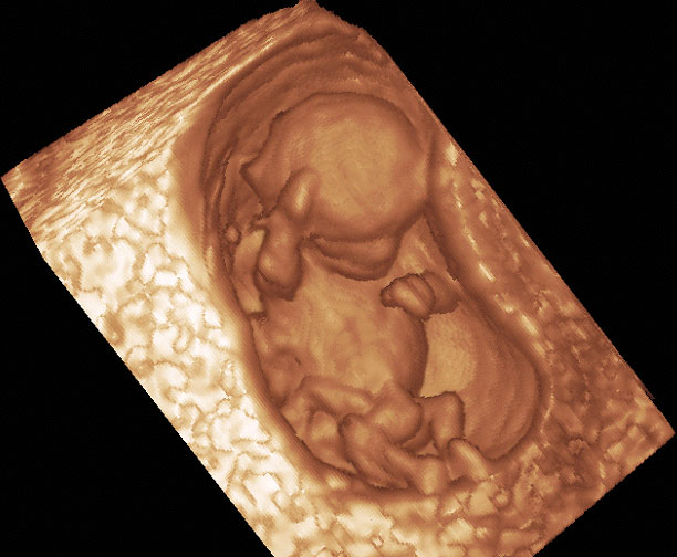 3D ультразвук на 13 неделе беременности
